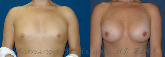 Breast Augmentation result at 4 Beauty Aesthetics Institute for Plastic Surgery: Dr. Constantino Mendieta in Miami, FL