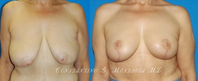 Breast Lift result at 4 Beauty Aesthetics Institute for Plastic Surgery: Dr. Constantino Mendieta in Miami, FL