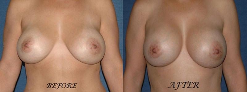 4 Beauty Aesthetics Institute for Plastic Surgery: Dr. Constantino Mendieta breast augmentation revision result — Miami, FL