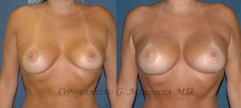 4 Beauty Aesthetics Institute for Plastic Surgery: Dr. Constantino Mendieta breast augmentation revision result — Miami, FL