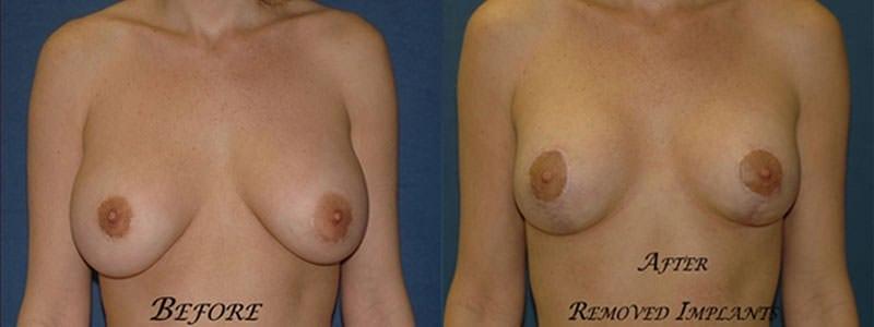 4 Beauty Aesthetics Institute for Plastic Surgery: Dr. Constantino Mendieta breast augmentation revision result — Miami, FL