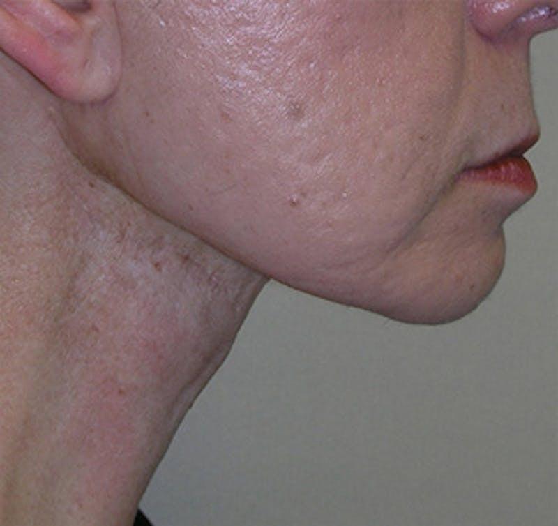 New Face NY facelift after — New York, NY
