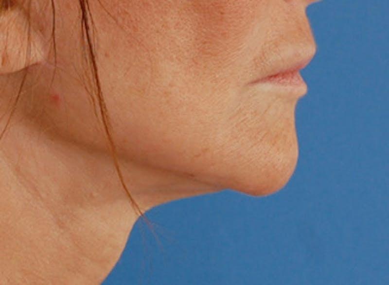 New Face NY facelift after — New York, NY