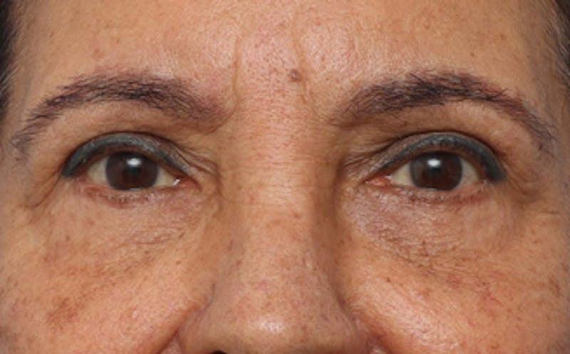 New Face NY eyelid lift after — New York, NY