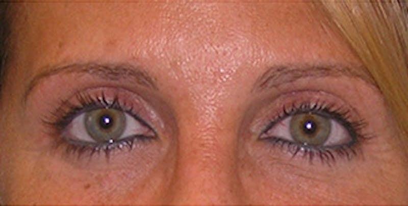 New Face NY eyelid lift after — New York, NY