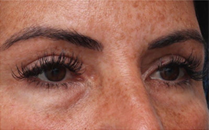 New Face NY eyelid lift after — New York, NY