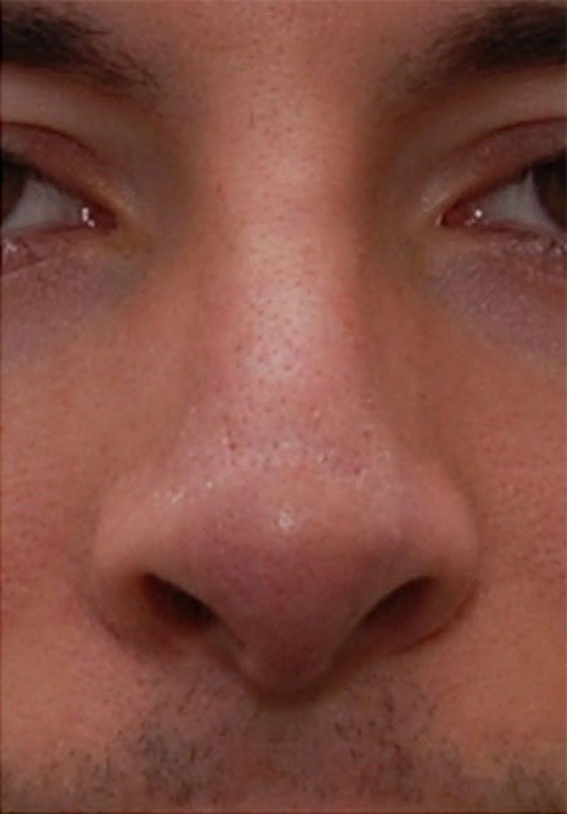 New Face NY liquid rhinoplasty after — New York, NY