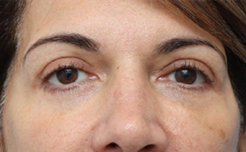 New Face NY eyelid lift after — New York, NY