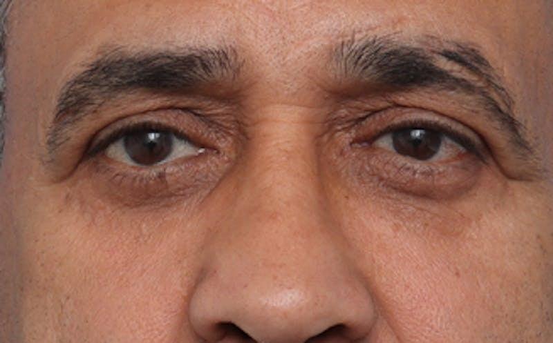 New Face NY eyelid lift after — New York, NY