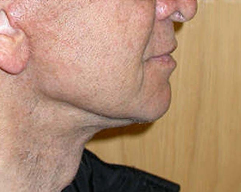 New Face NY facelift after — New York, NY