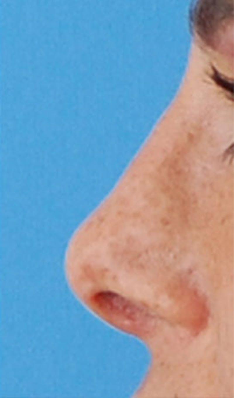 New Face NY liquid rhinoplasty after — New York, NY