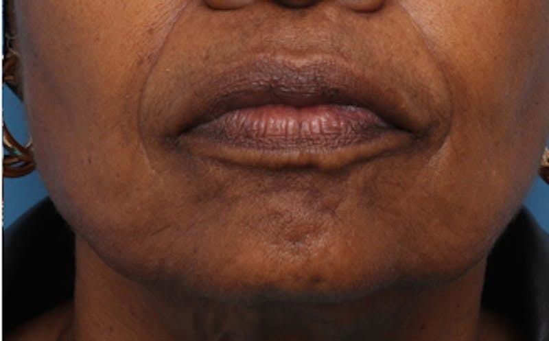 New Face NY fat transfer after — New York, NY