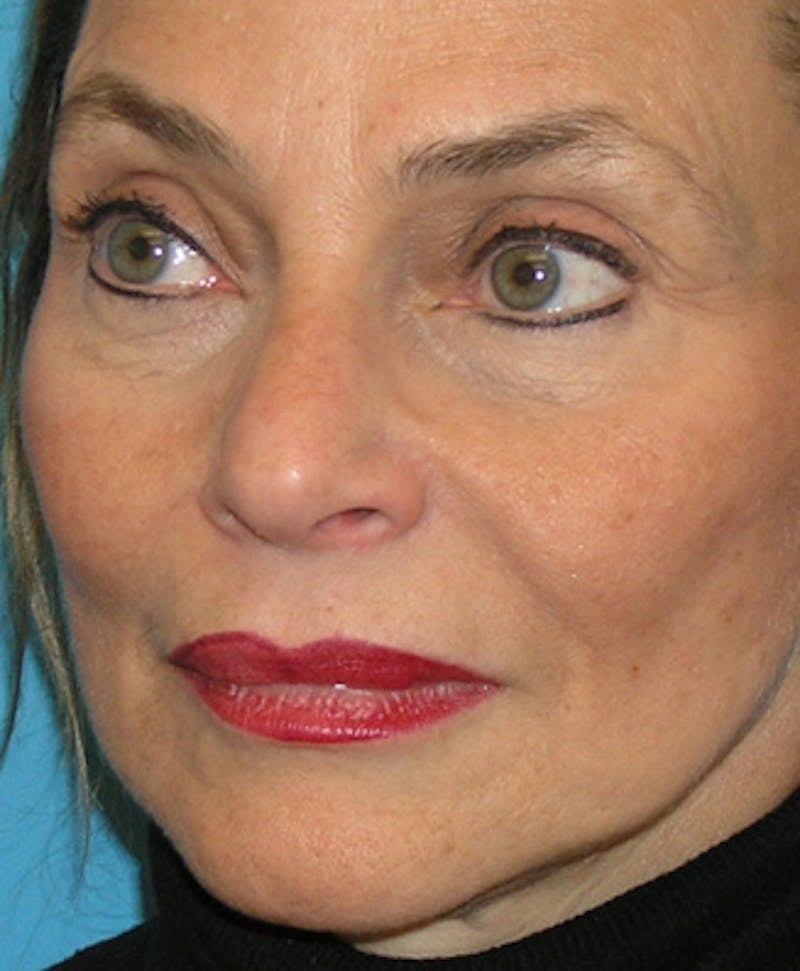 New Face NY facelift after — New York, NY