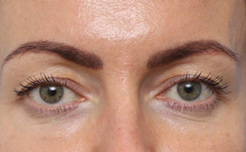 New Face NY fat transfer after — New York, NY