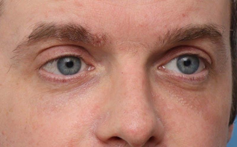 New Face NY fat transfer after — New York, NY