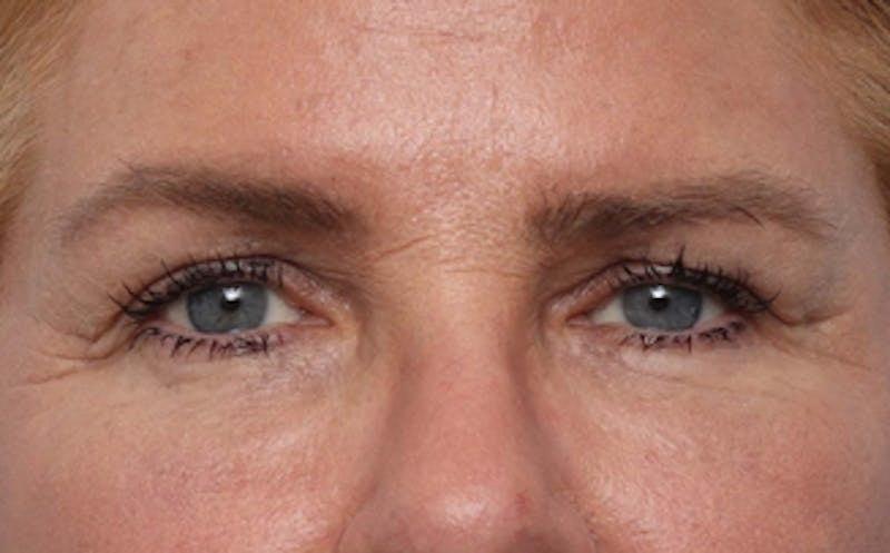 New Face NY fat transfer after — New York, NY