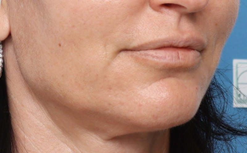 New Face NY fat transfer after — New York, NY