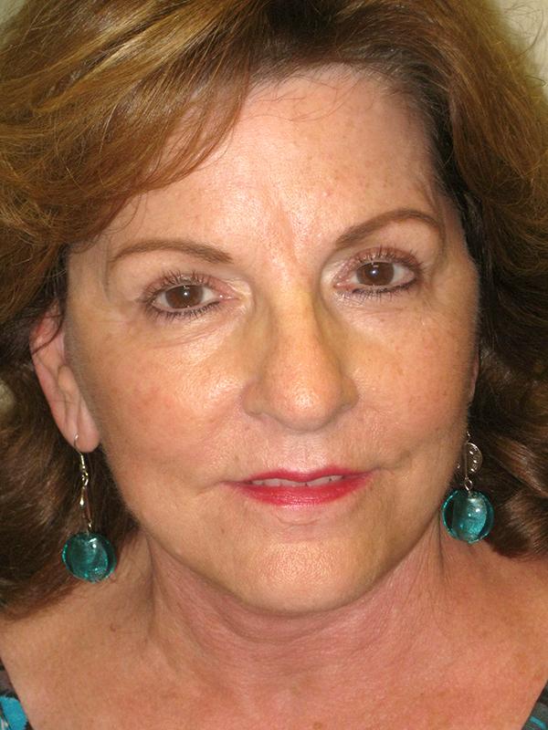 Facelift after at Lickstein Plastic Surgery in Palm Beach Gardens, FL