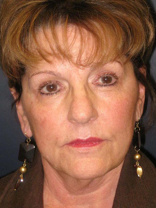 Facelift before at Lickstein Plastic Surgery in Palm Beach Gardens, FL