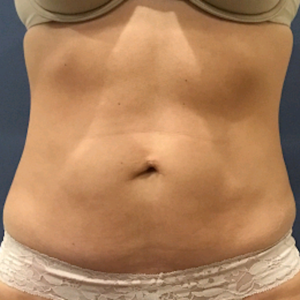 CoolSculpting after at Lickstein Plastic Surgery in Palm Beach Gardens, FL