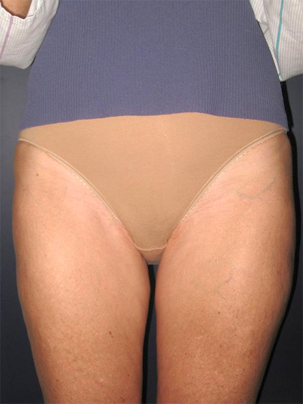 Liposuction after at Lickstein Plastic Surgery in Palm Beach Gardens, FL
