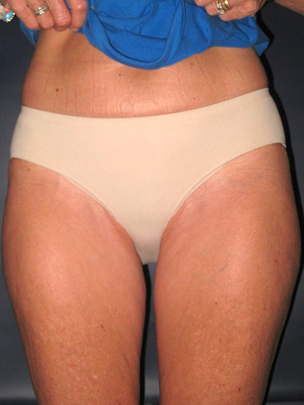 Liposuction before at Lickstein Plastic Surgery in Palm Beach Gardens, FL