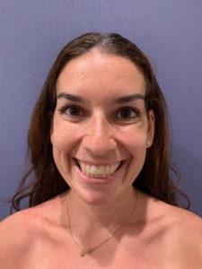 Botox after at Lickstein Plastic Surgery in Palm Beach Gardens, FL