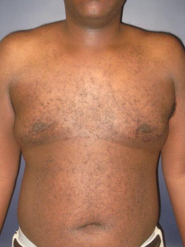 Lickstein Plastic Surgery gynecomastia after — Palm Beach Gardens, FL