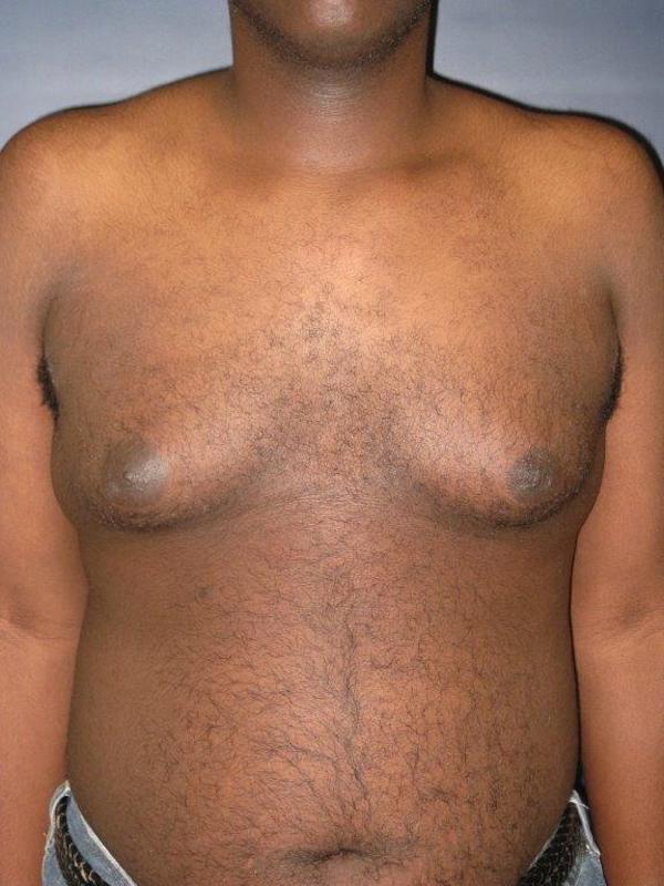 Gynecomastia Surgery before at Lickstein Plastic Surgery in Palm Beach Gardens, FL