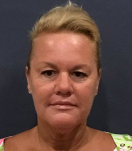 Lickstein Plastic Surgery botox after — Palm Beach Gardens, FL