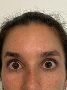 Lickstein Plastic Surgery botox after — Palm Beach Gardens, FL