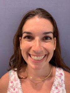 Botox before at Lickstein Plastic Surgery in Palm Beach Gardens, FL