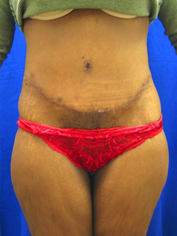 Tummy Tuck after at Lickstein Plastic Surgery in Palm Beach Gardens, FL
