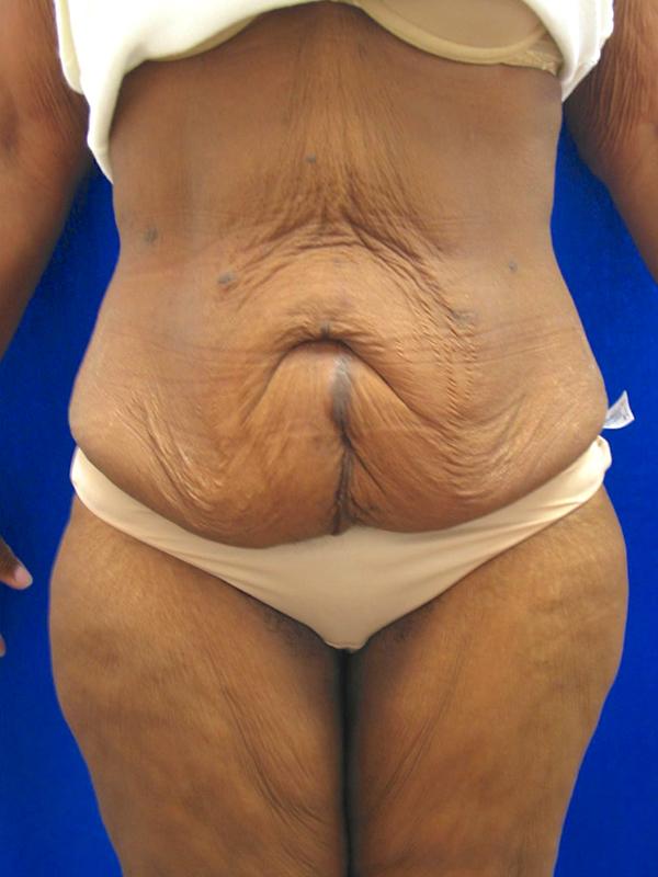 Tummy Tuck before at Lickstein Plastic Surgery in Palm Beach Gardens, FL