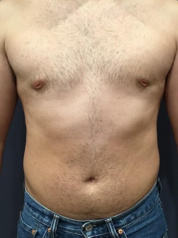 Lickstein Plastic Surgery gynecomastia after — Palm Beach Gardens, FL