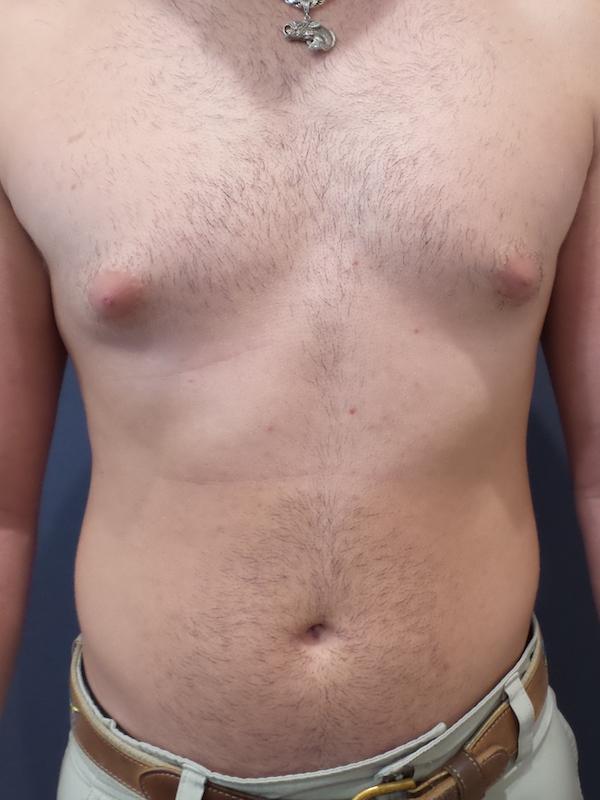 Gynecomastia Surgery before at Lickstein Plastic Surgery in Palm Beach Gardens, FL
