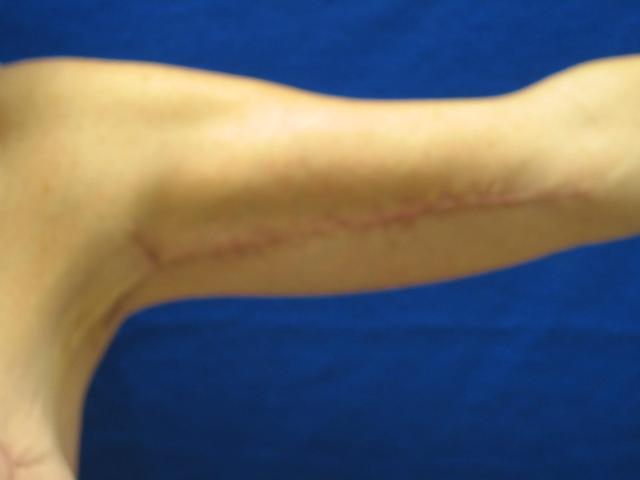 Arm Lift after at Lickstein Plastic Surgery in Palm Beach Gardens, FL