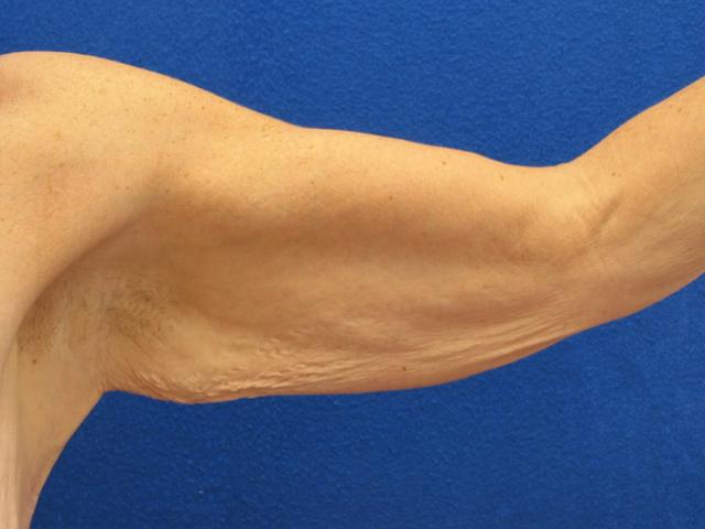 Arm Lift before at Lickstein Plastic Surgery in Palm Beach Gardens, FL
