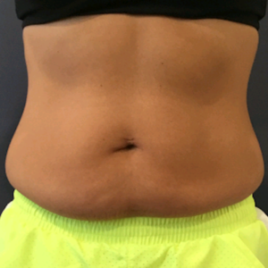 CoolSculpting before at Lickstein Plastic Surgery in Palm Beach Gardens, FL