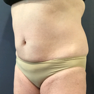 CoolSculpting after at Lickstein Plastic Surgery in Palm Beach Gardens, FL