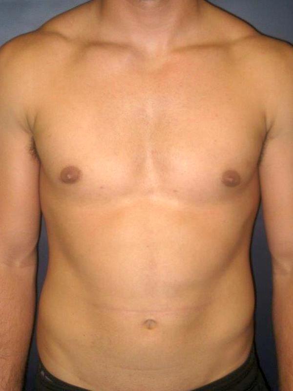 Lickstein Plastic Surgery gynecomastia after — Palm Beach Gardens, FL