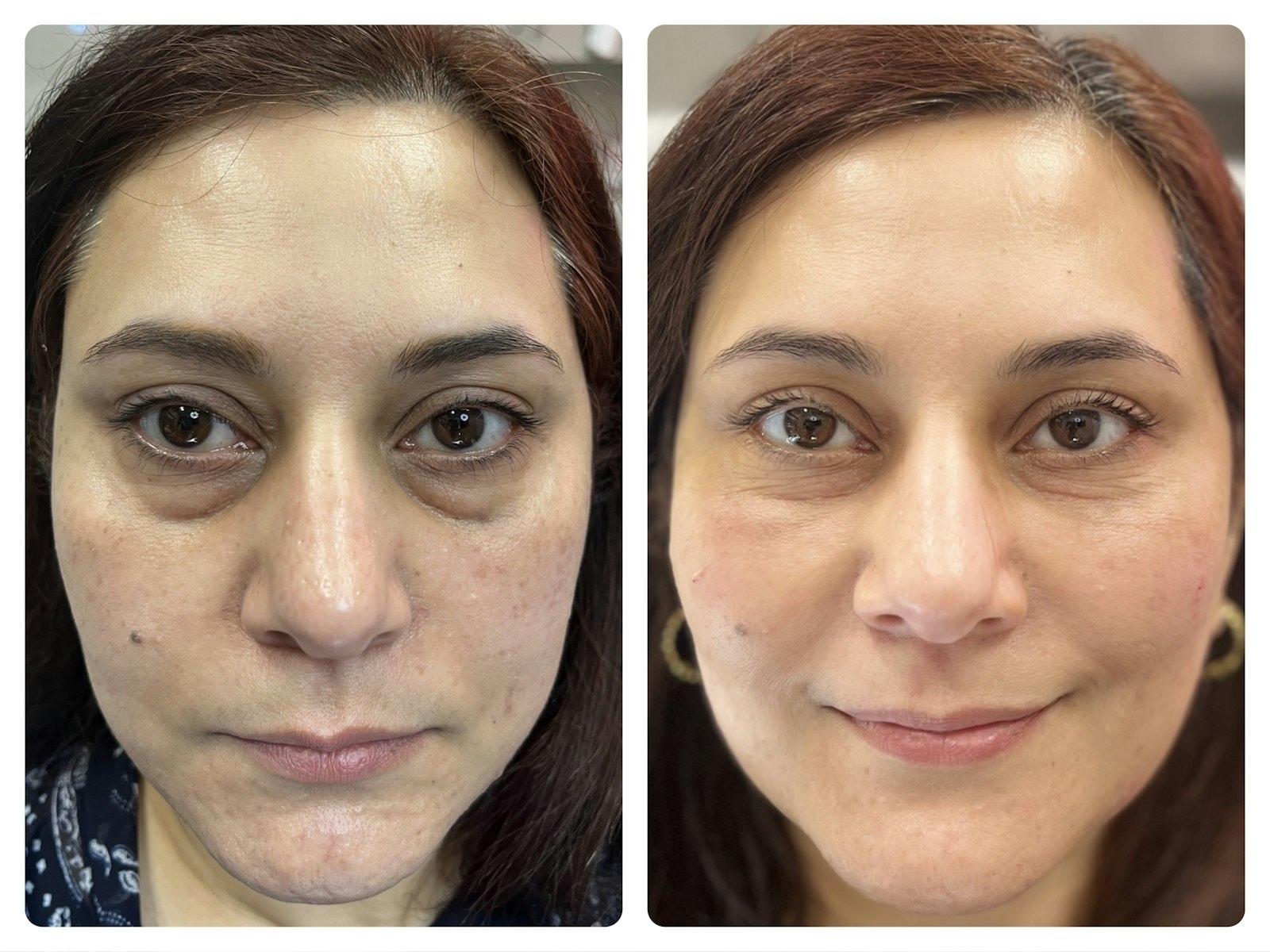 Chamata Plastic Surgery & Med Spa cheek filler result — Houston, TX