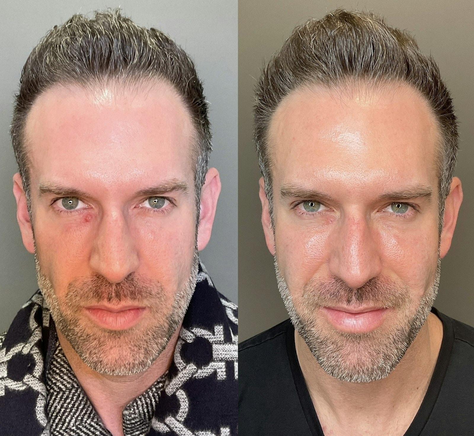 Chamata Plastic Surgery & Med Spa cheek filler result — Houston, TX