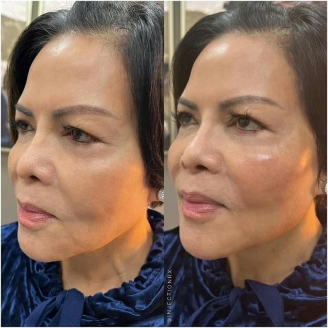 Dermal Fillers result at Chamata Plastic Surgery & Med Spa in Houston, TX