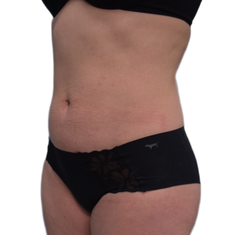 Envision Cosmetic Surgery liposuction after — Murray, UT