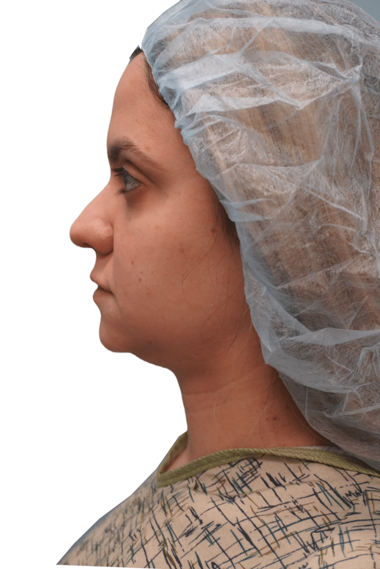 Envision Cosmetic Surgery rhinoplasty after — Murray, UT