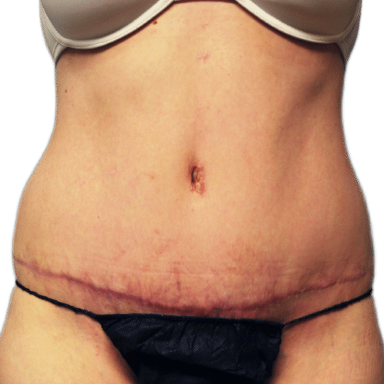 Envision Cosmetic Surgery liposuction after — Murray, UT