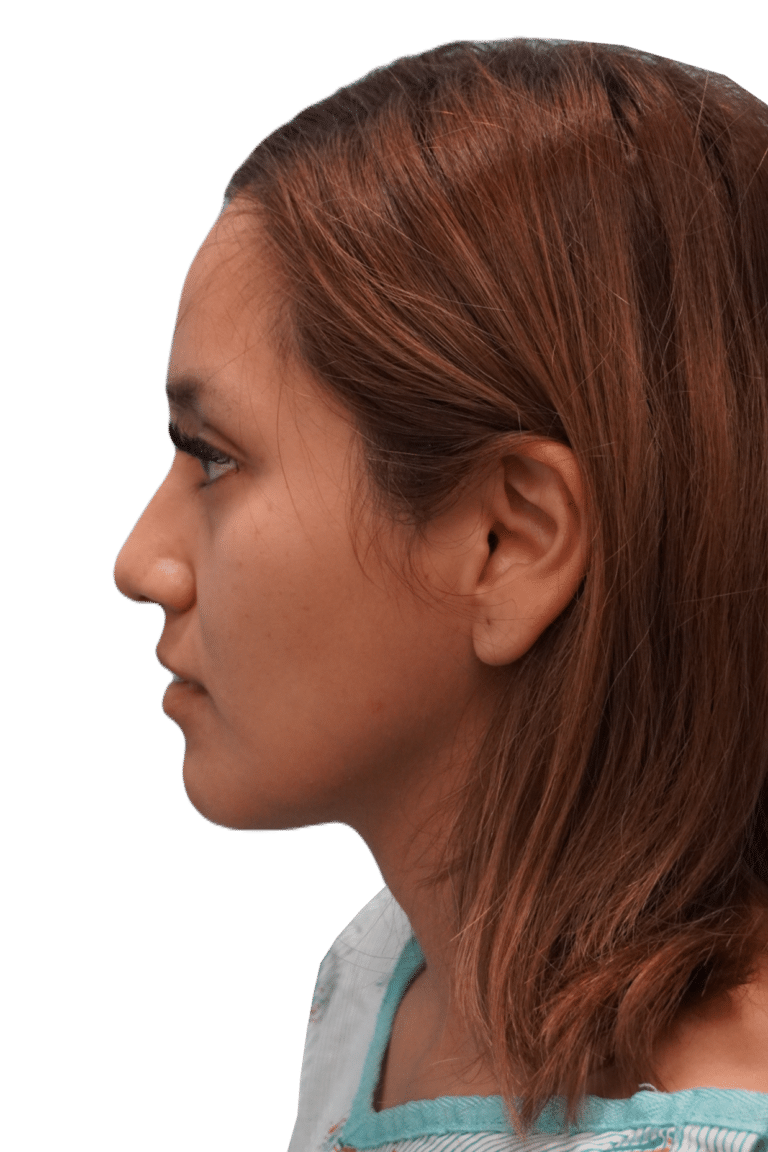 Envision Cosmetic Surgery rhinoplasty after — Murray, UT