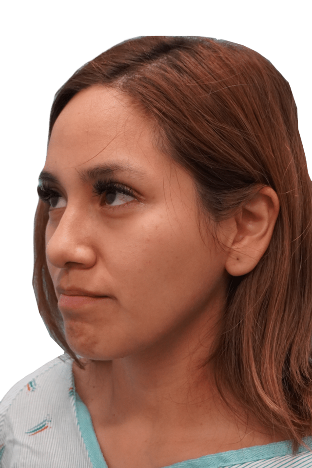 Rhinoplasty before at Envision Cosmetic Surgery in Murray, UT