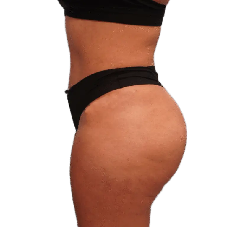 Envision Cosmetic Surgery liposuction after — Murray, UT